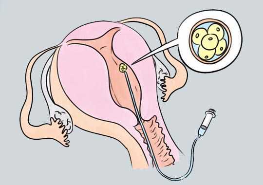 促排后的下一步做什么?插图