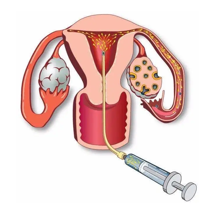 什么是宫腔内人工授精（IUI）插图