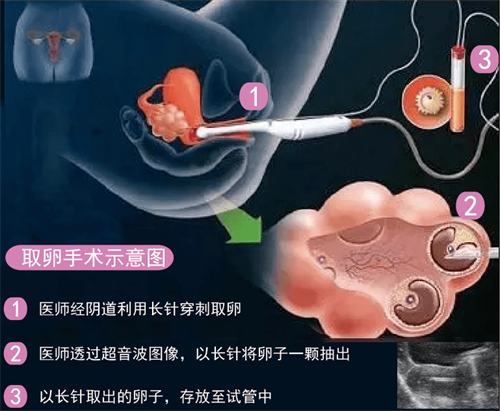 试管婴儿借用别人精子需要多少钱?国内医院做借精试管的条件是什么?插图1 undefined