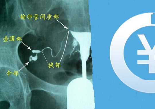 输卵管造影多少钱？插图