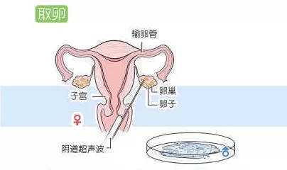 试管取卵越多，试管婴儿成功率就越高吗？插图