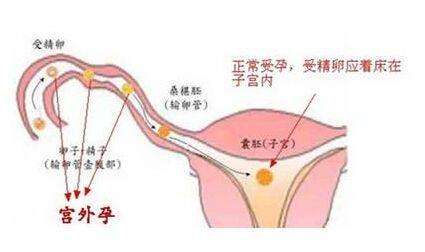 第一次试管婴儿移植失败后必须刮宫吗？插图